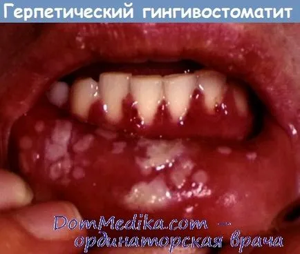 Херпесна gingivostomatitis - диагностика, лечение