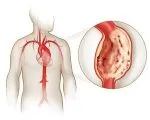 Hypoplasiája aorta típusú, a tünetek és a kezelés a betegség