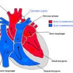 Hypoplasiája aorta típusú, a tünetek és a kezelés a betegség