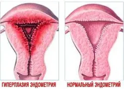 hiperplazie endometrială 1