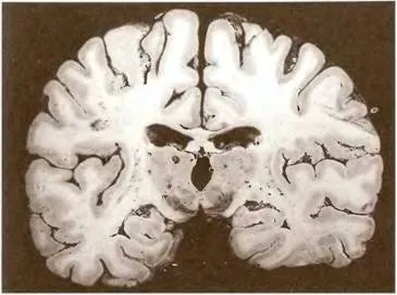 Hipertensive mici infarcte profunde - patologia cerebrală a aterosclerozei și a