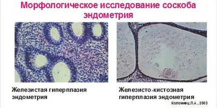 хиперплазия на ендометриума