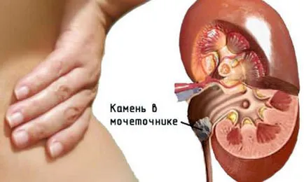 бъбрек хидронефроза - симптоми, лечение, причини, отколкото опасно