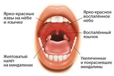 Гнойни некротизиращ Simanovskiy Vincent ангина симптоми, лечение