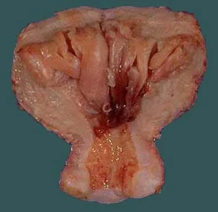 hiperplazie endometrială