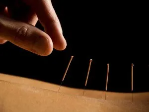 Acupunctura hernie in comentarii coloanei vertebrale lombare