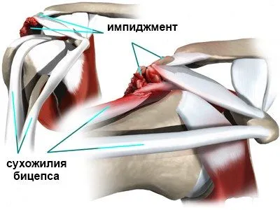 синдром съвместен посегателство дясното рамо - причини и лечение