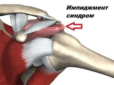 синдром съвместен посегателство дясното рамо - причини и лечение