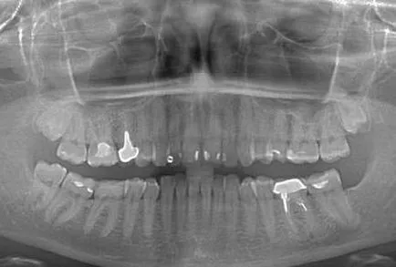 Az implantátumok Dental tooth-Mogilev