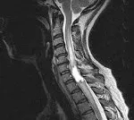 Intramedular măduvei spinării tumorale - cauze, simptome, diagnostic și tratament