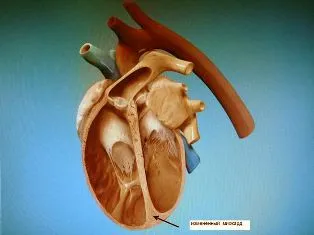 Исхемична кардиомиопатия - сърцето лечение