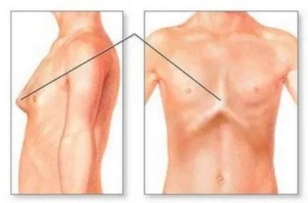 Извивката на гръдния кош причинява, видове, лечение