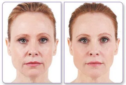 Preparate injectabile (injecții) de acid hialuronic faciale contraindicații, avantaje și dezavantaje