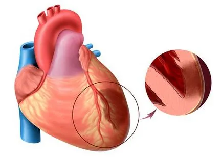 Szívkoszorúér-betegség és stent beültetést az erek a szív