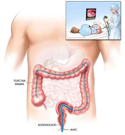 Иригография или колоноскопия - което е по-добре