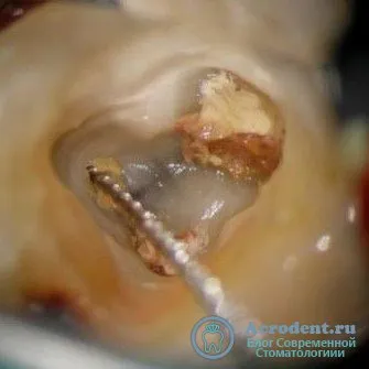 Izolarea câmpului chirurgical