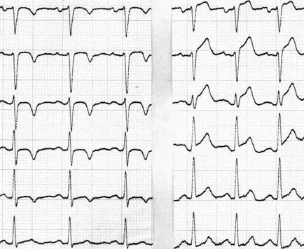 EKG változások során a stressz