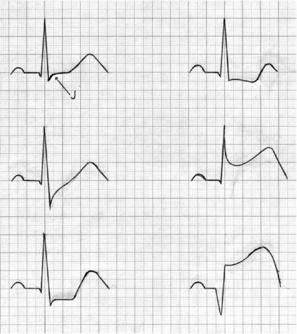 EKG változások során a stressz