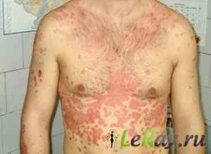 Cum de a realiza remisie psoriazis persistente