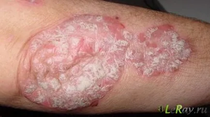 Hogyan lehet elérni a tartós psoriasis elengedés