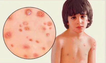 Какви може да са усложненията на варицелата
