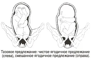 Как да се идентифицират седалищно предлежание представяне себе си, плода представяне