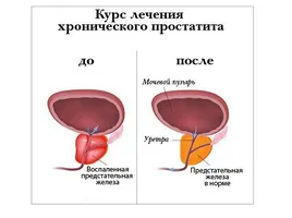 Как е лазерно лечение на ДПХ