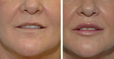 Hogyan növelhető az ajkak Botox Botox ajak korrekció
