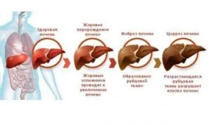 Сърдечни цироза симптоми, лечение, прогноза