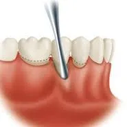 Коагулацията венци в стоматологията