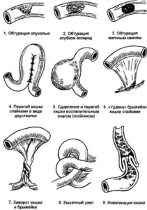 Tipuri de ileus și forme, cauze si tratament