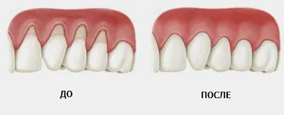 Коагулацията венци в стоматологията