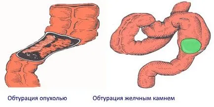 Илеус видове, симптоми, причини, лечение