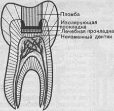 Лечение на зъбен кариес на запечатване