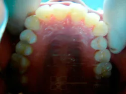 Лечение на дисталните оклузия и подравняване зъби