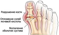 Лечение на болки в костите в петите, лекарствата от народната медицина