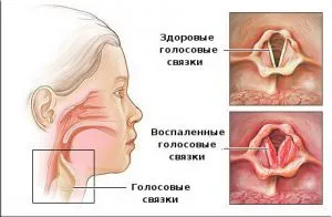 лечение Ларингит при възрастни ларинкса възпаление