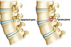 A kezelés a porckorongsérv - homeopátiás klinika „abriell”