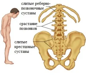 remedii populare de tratament boala Bechterew, celulele stem Bubnovskogo și metoda