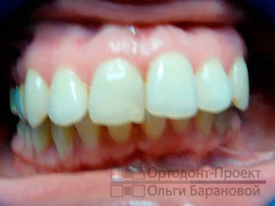Лечение на дисталните оклузия и подравняване зъби