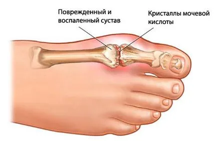 Лечение на болки в костите в петите, лекарствата от народната медицина