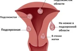 Tratamentul pe bază de plante în ginecologie