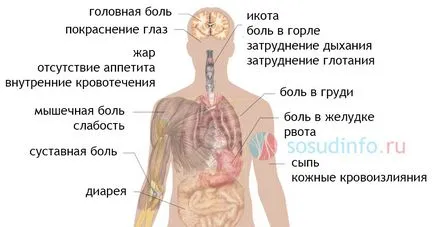 virusul Ebola, simptome, tratament, vaccin