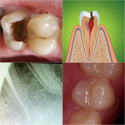 Лечение на пародонтит на постоянни и временни зъби
