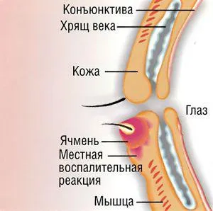 Meybomit долния клепач симптоми и лечение у дома в едно дете и един възрастен, ечемик