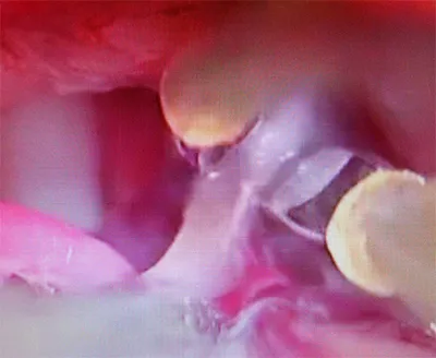 Microneurosurgery trigeminus neuralgia