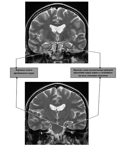 Microneurosurgery trigeminus neuralgia