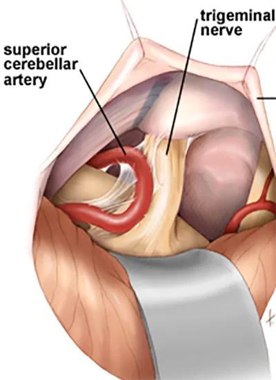 Microneurochirurgie nevralgie de trigemen