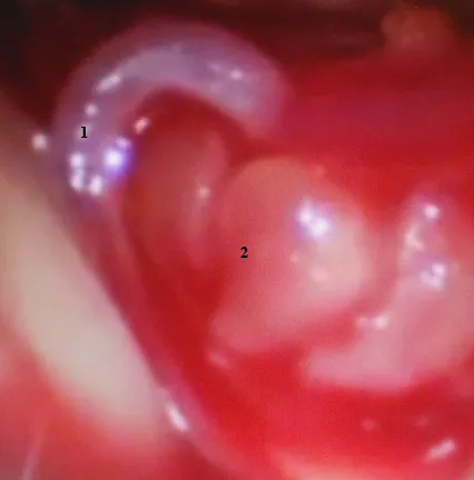 Microneurosurgery trigeminus neuralgia