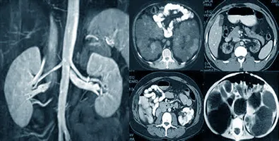 MRI retroperitoneum - mely hatóságok ellenőrzéseket és milyen betegségek mutatni